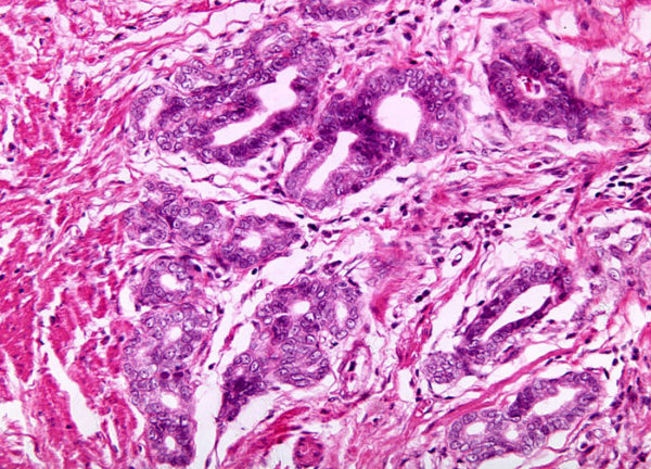 Так выглядит под микроскопом фрагмент ткани железистого рака желудка